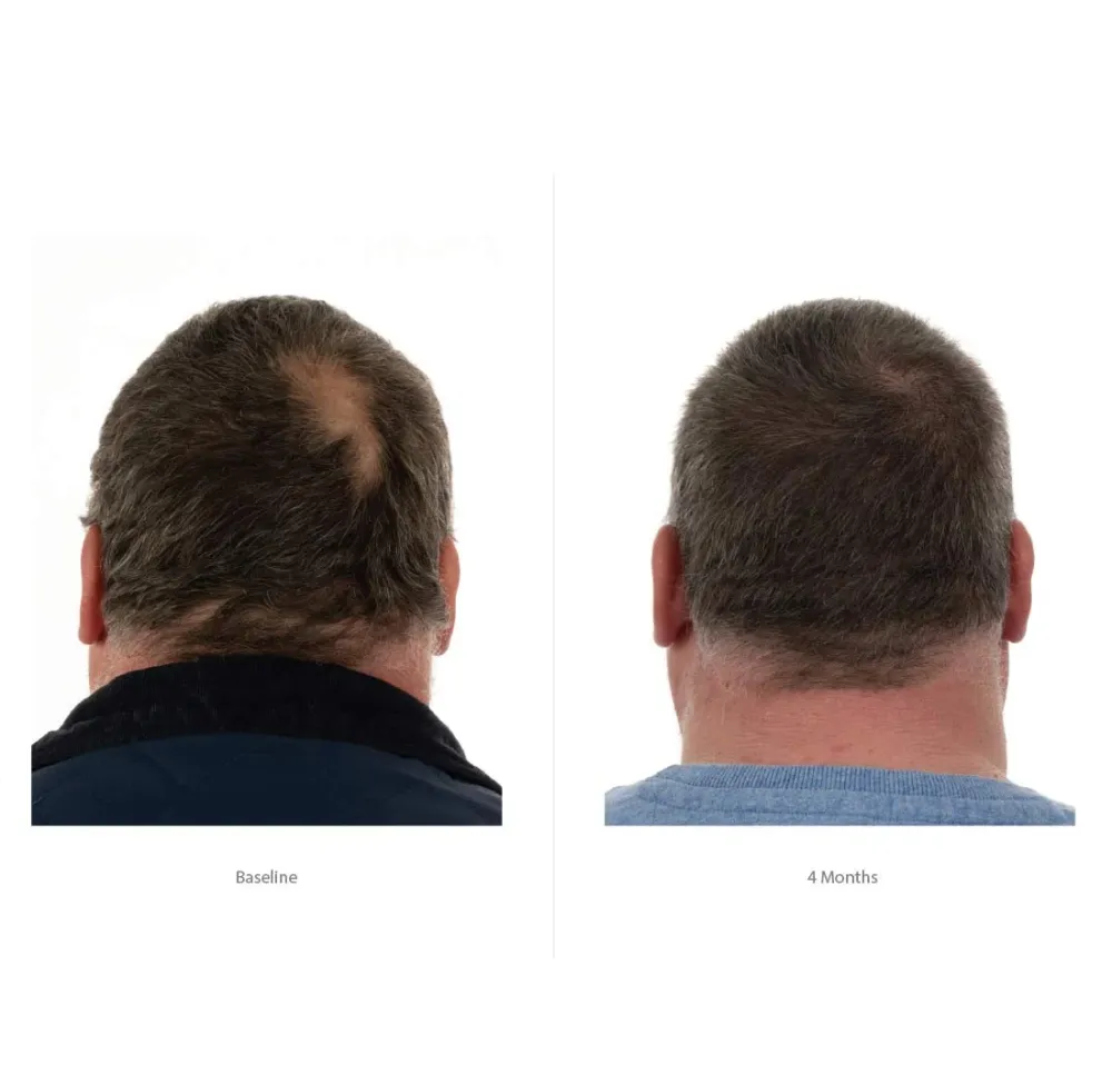 FOLIGAIN šampon trostrukog djelovanja za prorjeđenu kosu za muškarce s 2% TRIOXIDIL® 473ml