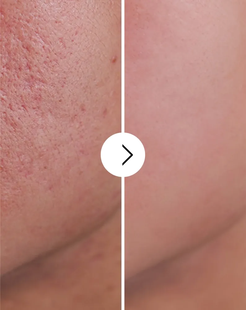 Tablete za akne, prištiće i nesavršenosti sa cinkom, vitaminom C, E i B2 Derminax
