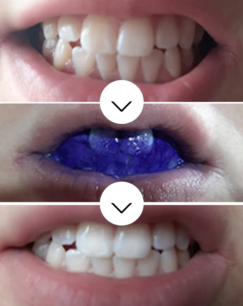 Serum za izbjeljivanje zubi White Bite Smilebite 30 ml