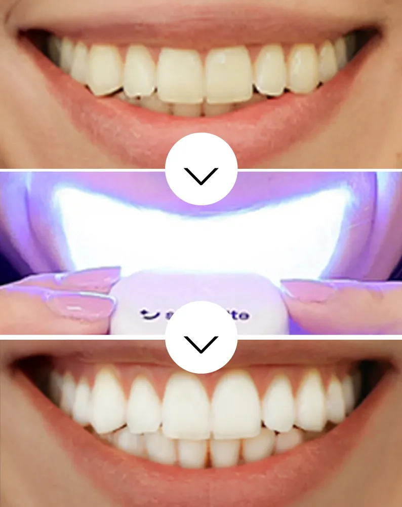 Smilebite Light & Bright Set za izbjeljivanje zubi LED lampa + Whitesmile Serum™